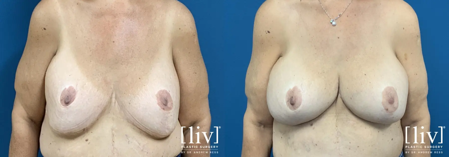 Breast Implant Exchange and Repositioning - Before and After  