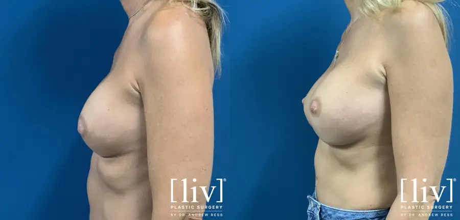 Breast Implant Exchange - Before and After 3