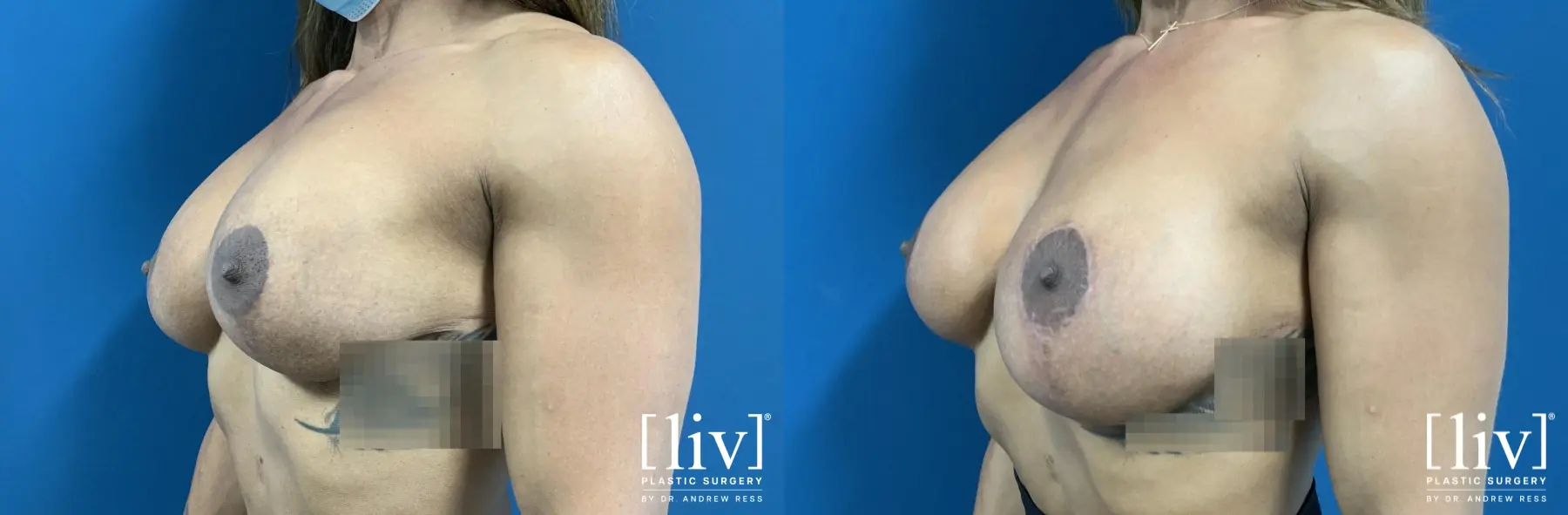 Breast Implant Exchange and Capsulectomy - Before and After 2