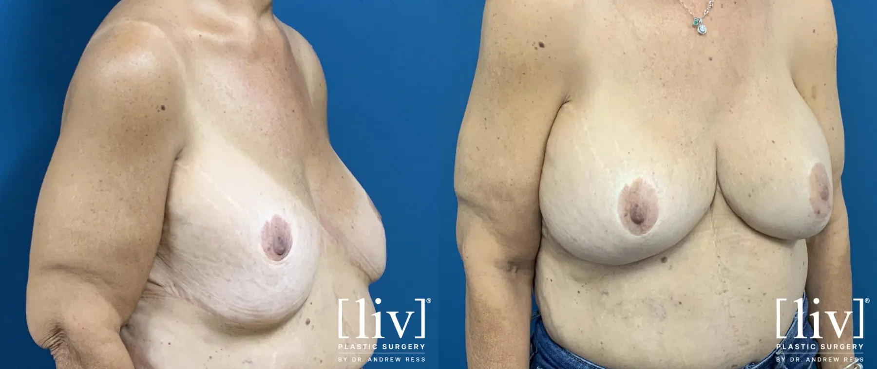 Breast Implant Exchange and Repositioning - Before and After 4