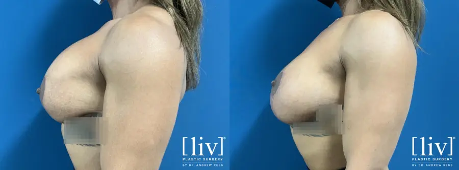 Breast Implant Exchange and Capsulectomy - Before and After 3