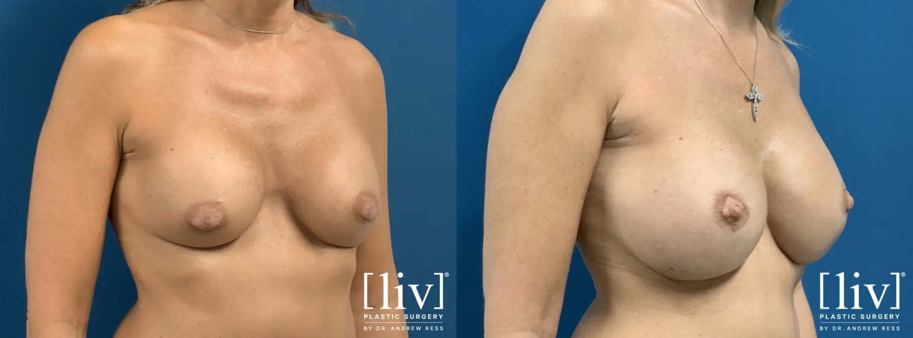 Breast Implant Exchange - Before and After 4