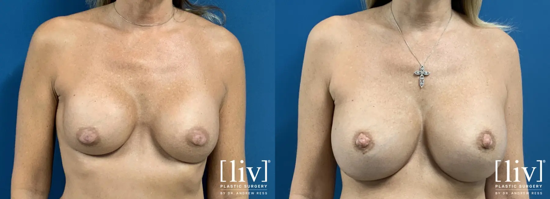 Breast Implant Exchange - Before and After 1