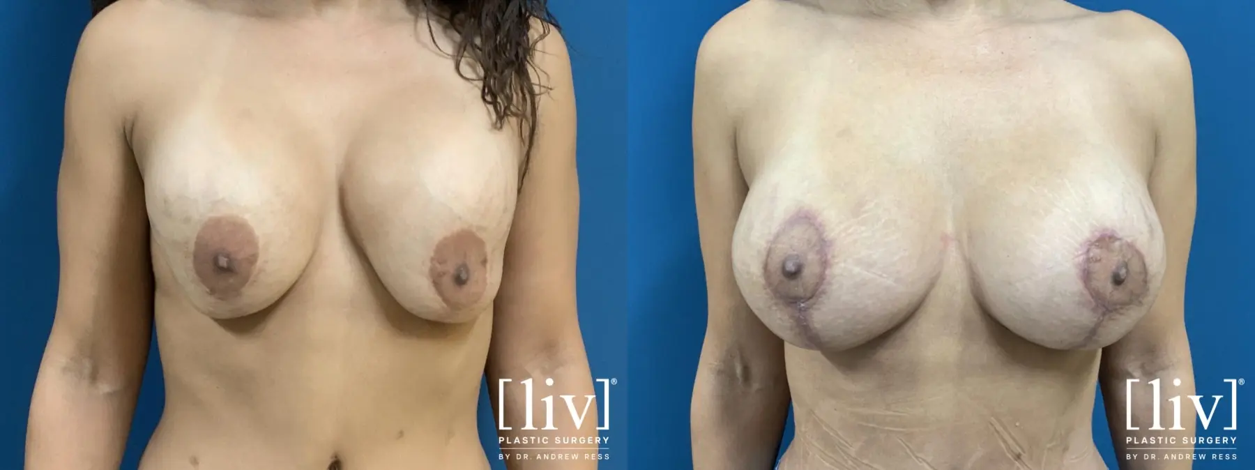 Breast Lift and Implant Exchange - Before and After  