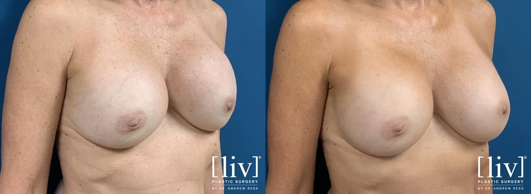 Breast Implant Exchange and Capsulotomy - Before and After 2
