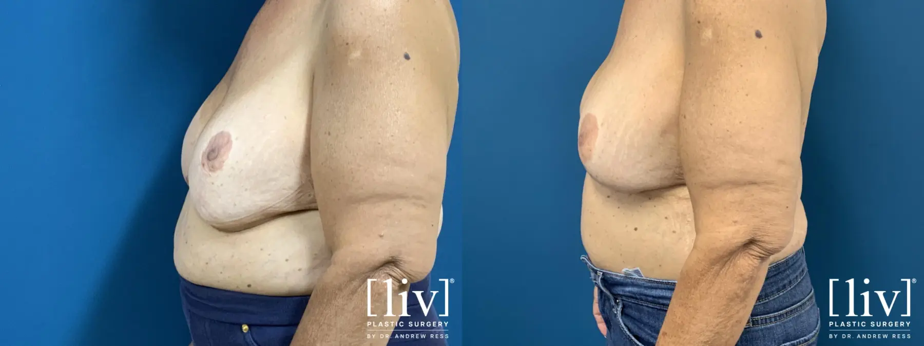 Breast Implant Exchange and Repositioning - Before and After 3