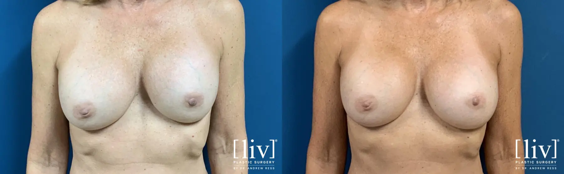 Breast Implant Exchange and Capsulotomy - Before and After 1