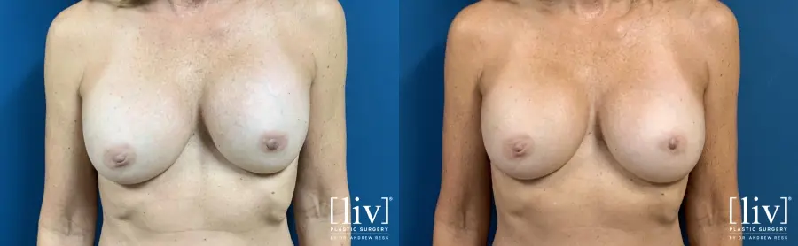 Breast Implant Exchange and Capsulotomy - Before and After  