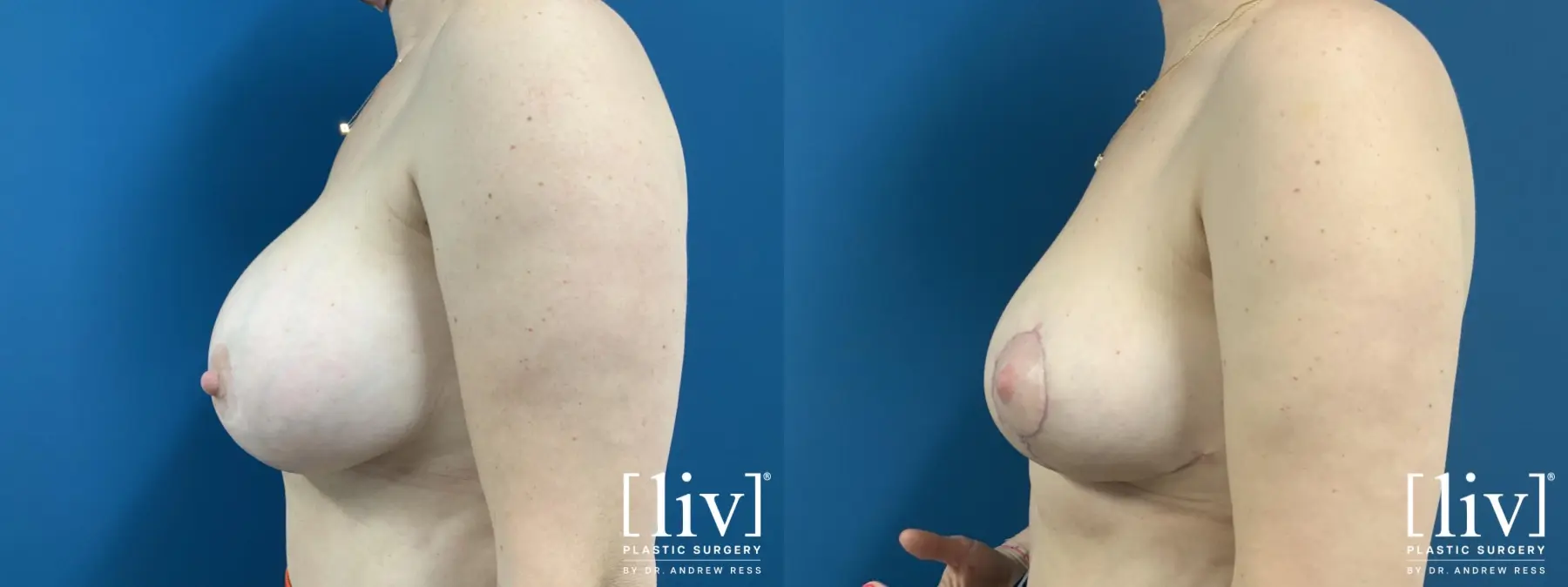Implant removal with Breast Lift and Fat Transfer to Breast  - Before and After 3
