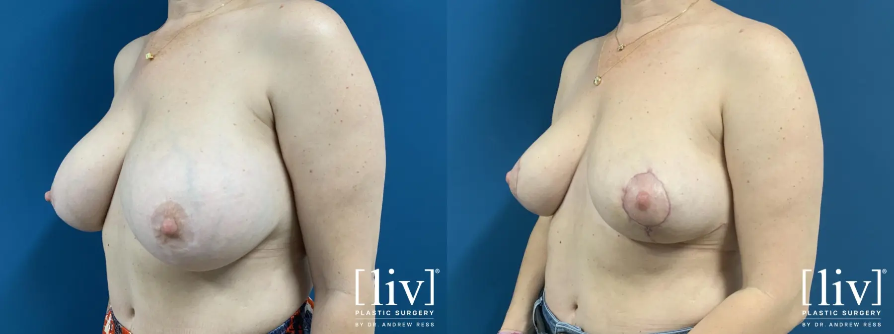 Implant removal with Breast Lift and Fat Transfer to Breast - Before and After 2