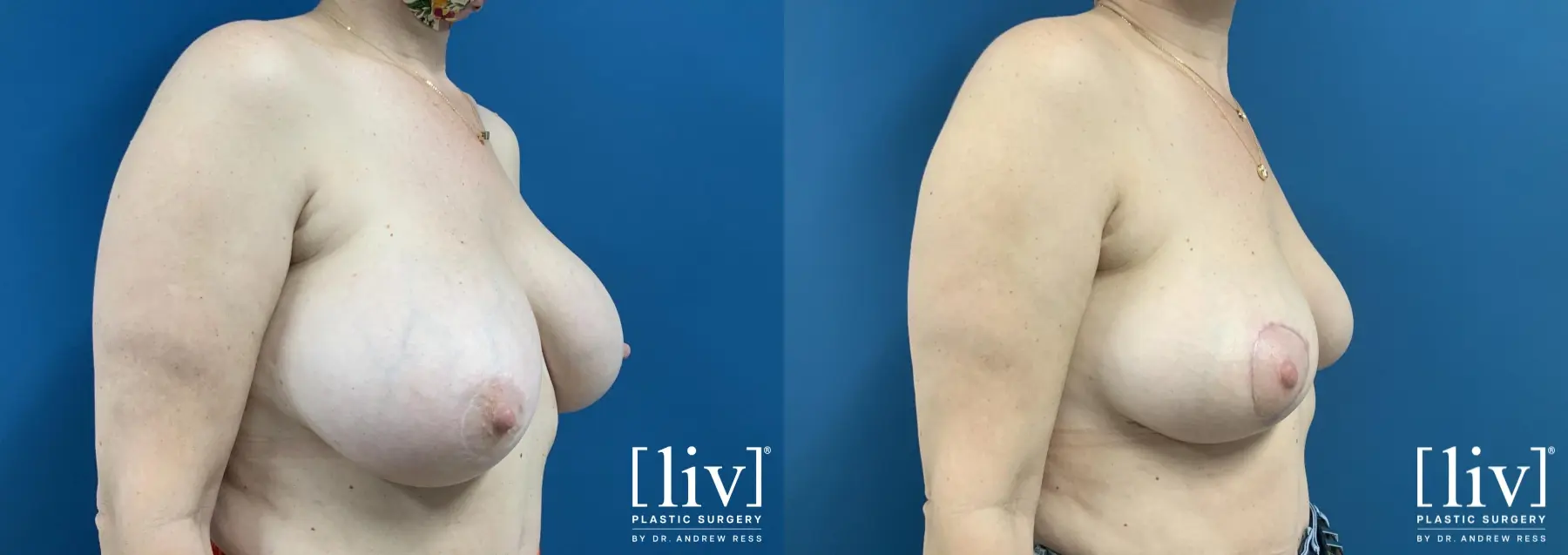 Implant removal with Breast Lift and Fat Transfer to Breast - Before and After 4