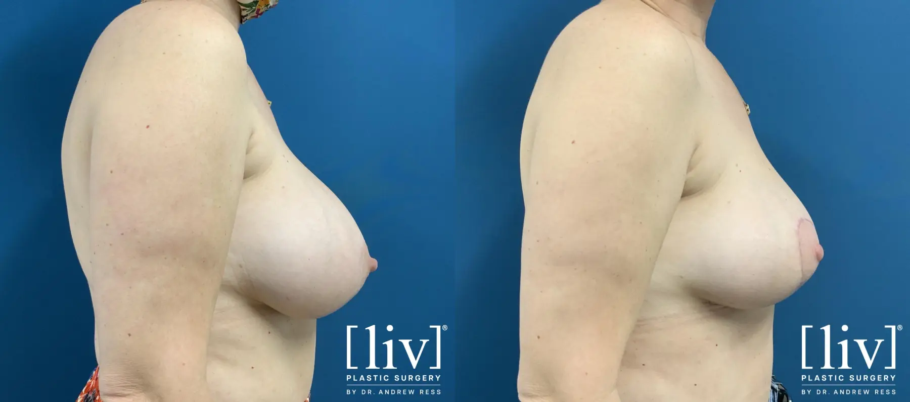 Implant removal with Breast Lift and Fat Transfer to Breast  - Before and After 5