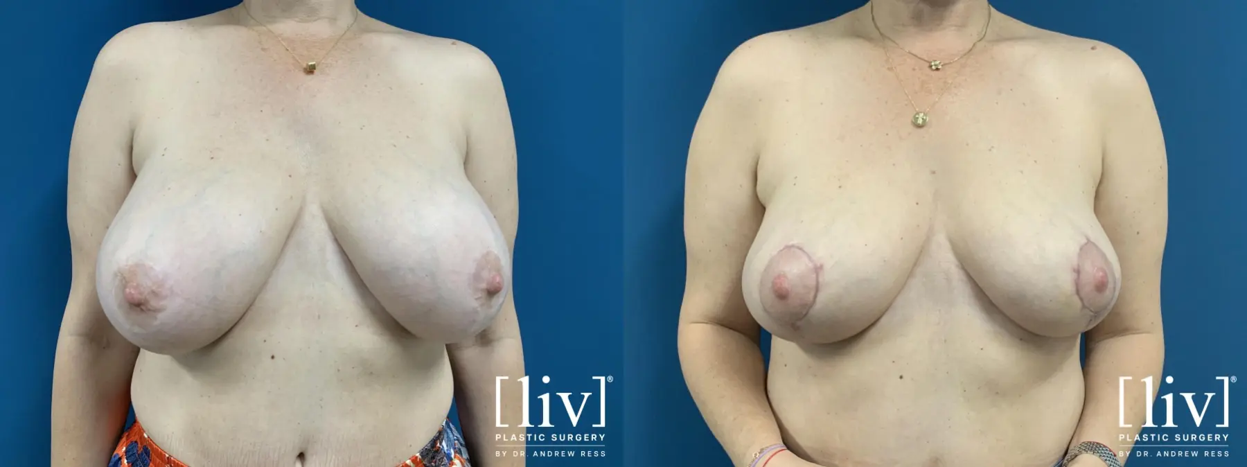 Implant removal with Breast Lift and Fat Transfer to Breast  - Before and After 1