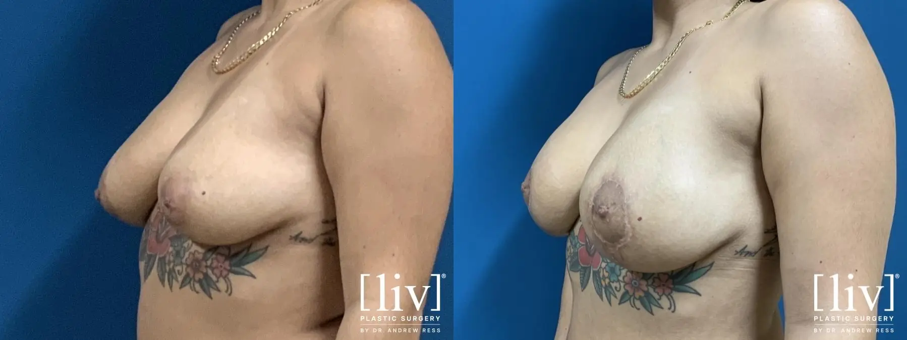 Breast Lift And Augmentation: Patient 2 - Before and After 2