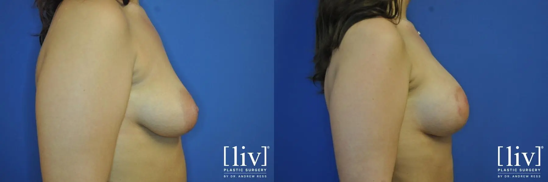 Breast Lift And Augmentation: Patient 5 - Before and After 5