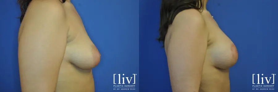 Breast Lift And Augmentation: Patient 5 - Before and After 5