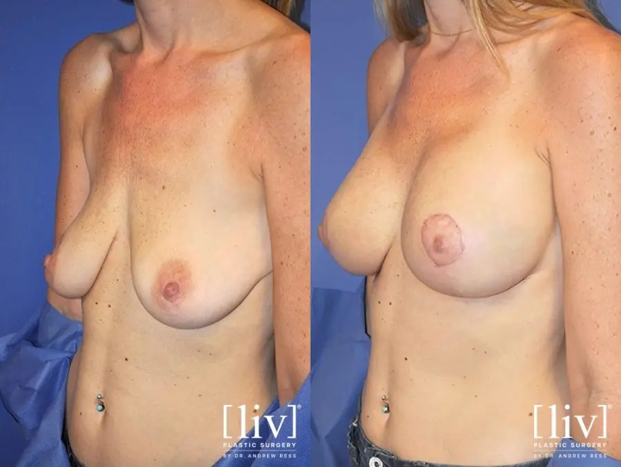 Breast Lift And Augmentation: Patient 12 - Before and After 1