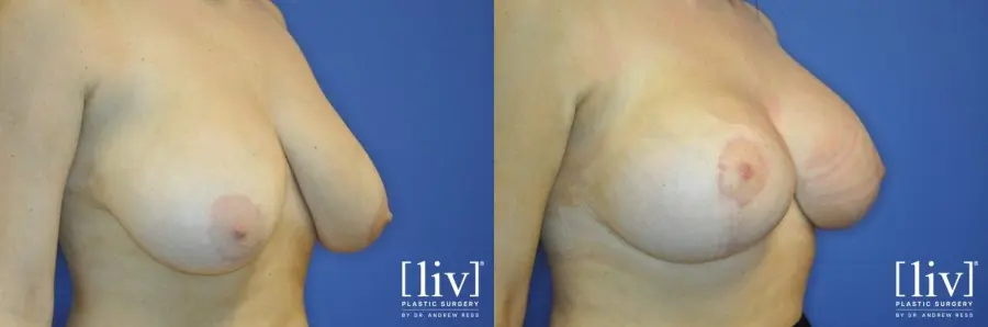 Breast Lift And Augmentation: Patient 6 - Before and After 2