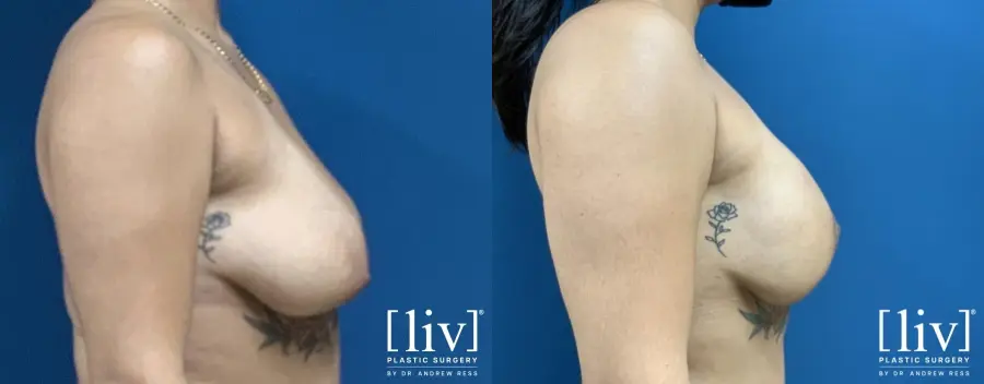 Breast Lift And Augmentation: Patient 2 - Before and After 5
