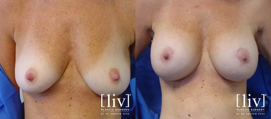Breast Lift And Augmentation: Patient 3 - Before and After 1