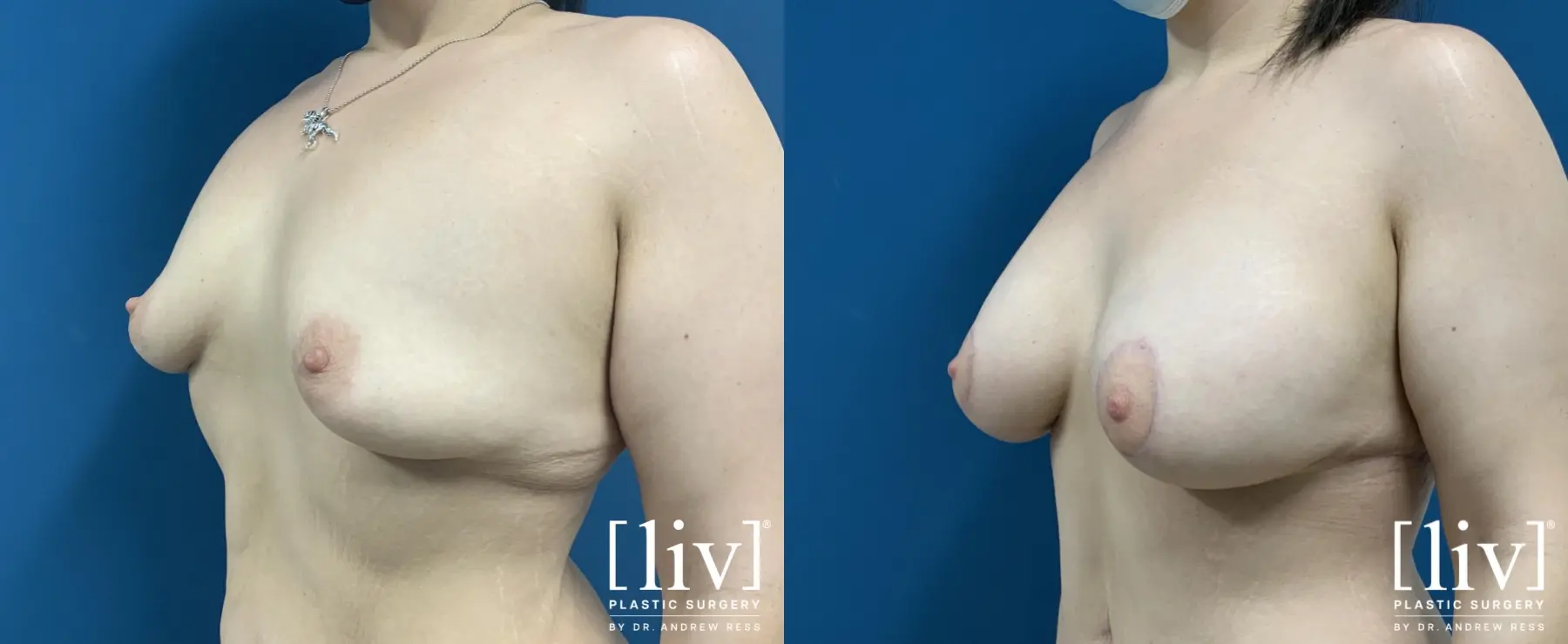 Breast Lift And Augmentation: Patient 15 - Before and After 2