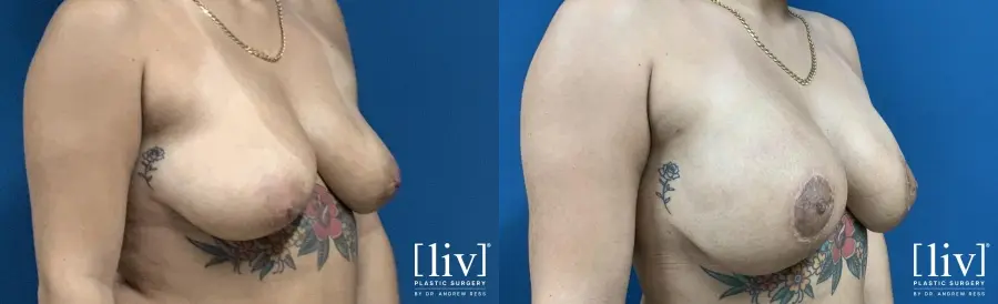 Breast Lift And Augmentation: Patient 2 - Before and After 4