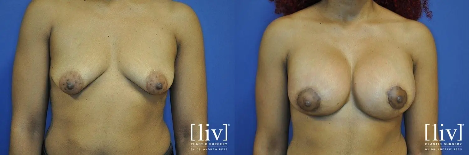 Breast Lift And Augmentation: Patient 11 - Before and After 1