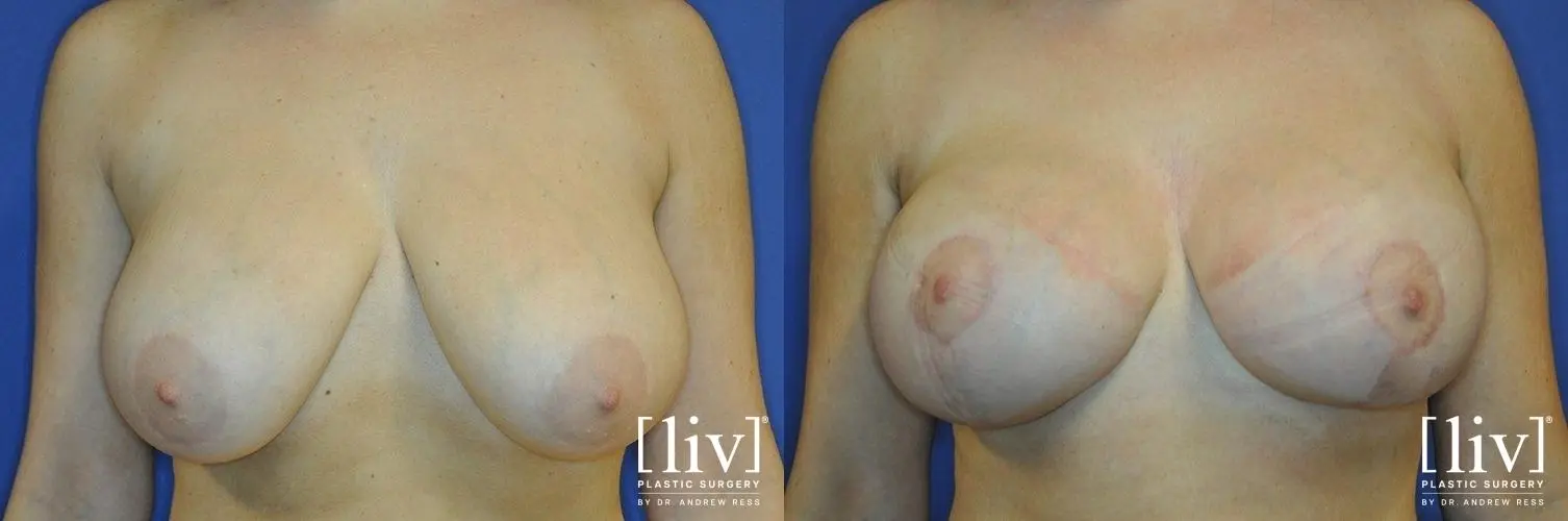 Breast Lift And Augmentation: Patient 6 - Before and After 1