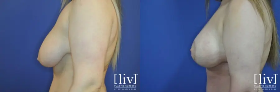 Breast Lift And Augmentation: Patient 9 - Before and After 3