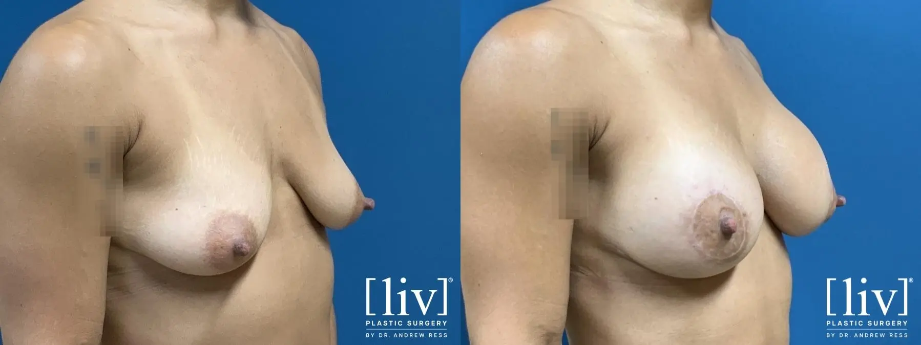Breast Lift And Augmentation: Patient 1 - Before and After 2