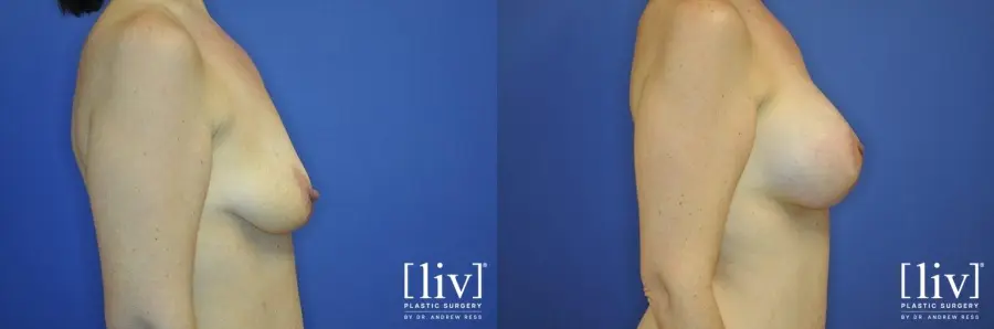 Breast Lift And Augmentation: Patient 4 - Before and After 3