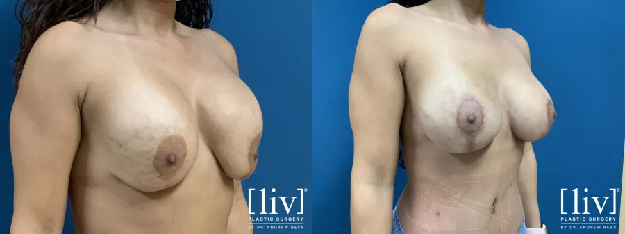 Breast Lift and Implant Exchange - Before and After 4