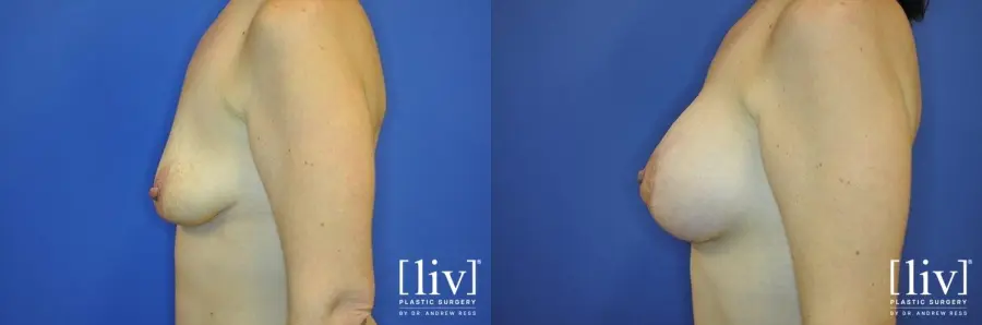 Breast Lift And Augmentation: Patient 7 - Before and After 5