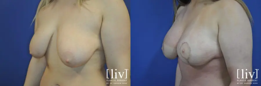 Breast Lift And Augmentation: Patient 9 - Before and After 2