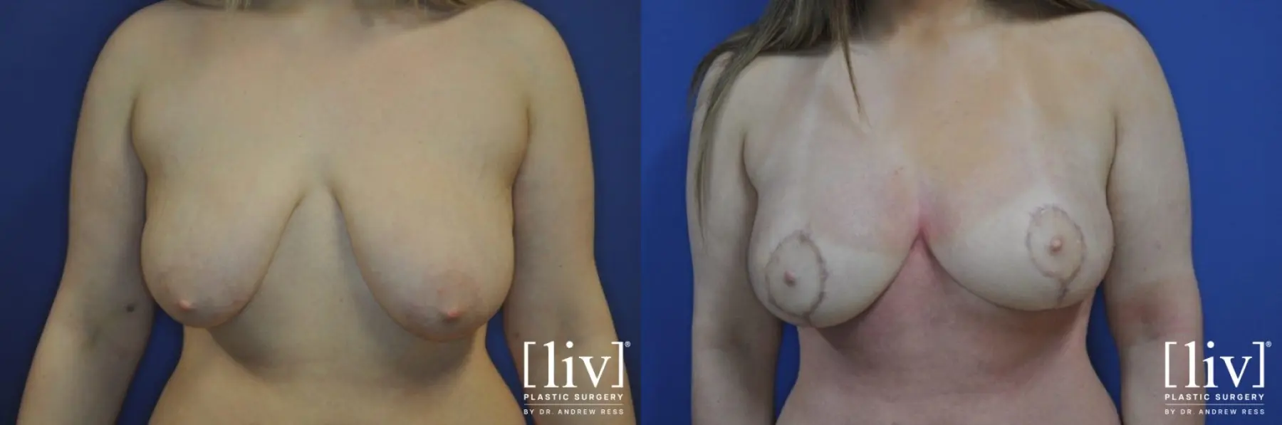 Breast Lift And Augmentation: Patient 9 - Before and After 1