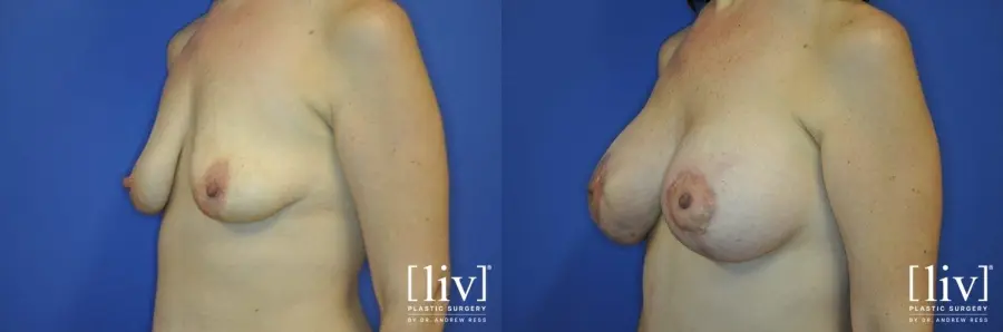 Breast Lift And Augmentation: Patient 7 - Before and After 4