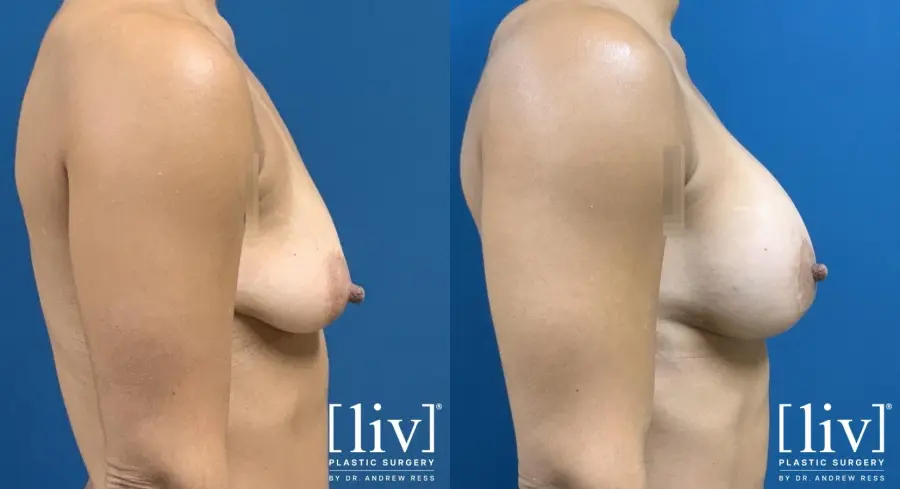 Breast Lift And Augmentation: Patient 1 - Before and After 3
