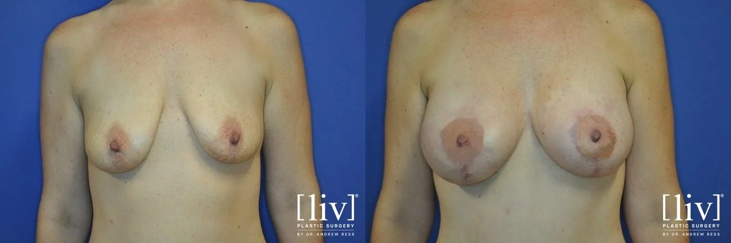 Breast Lift And Augmentation: Patient 4 - Before and After 1