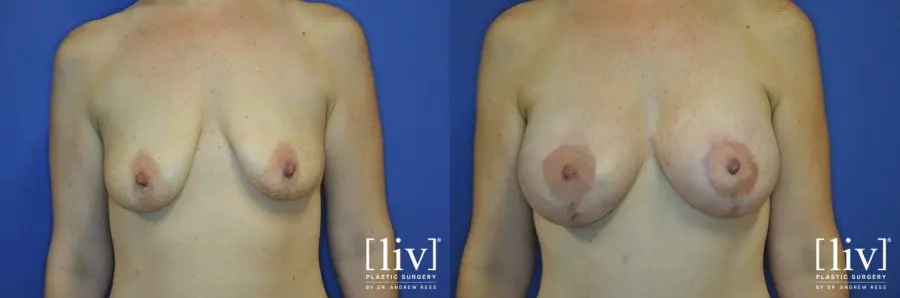 Breast Lift And Augmentation: Patient 4 - Before and After  