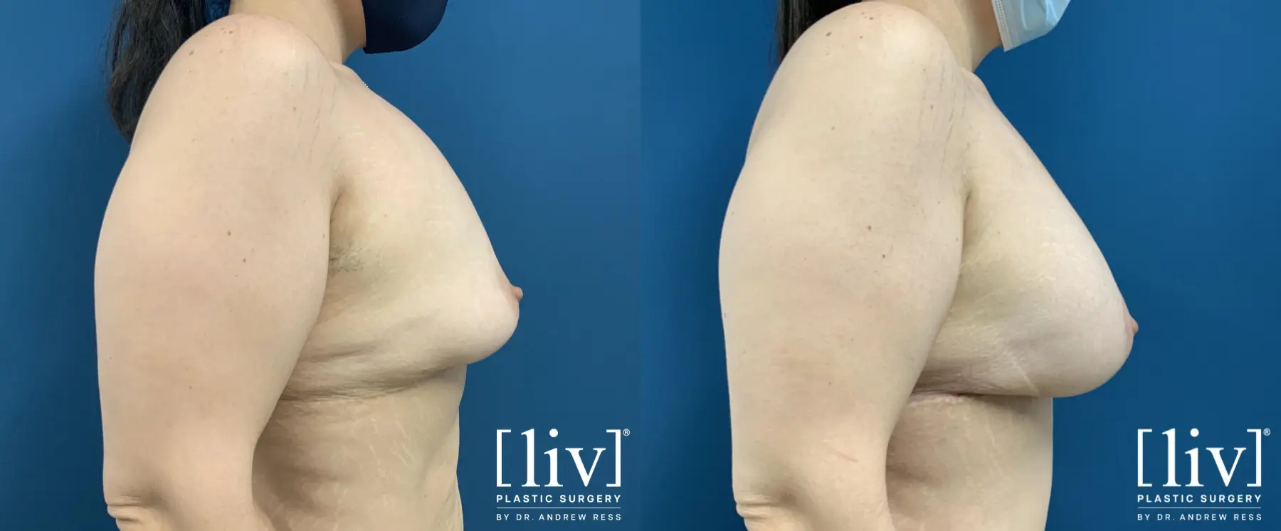 Breast Lift And Augmentation: Patient 15 - Before and After 5