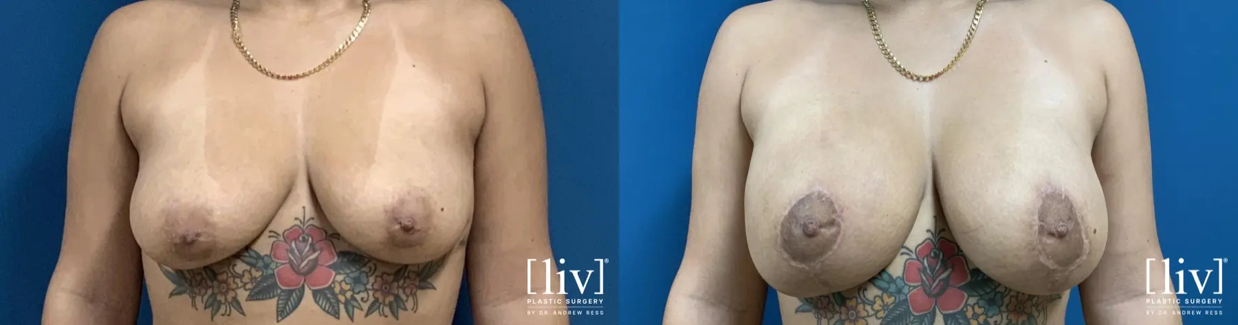 Breast Lift And Augmentation: Patient 2 - Before and After 1