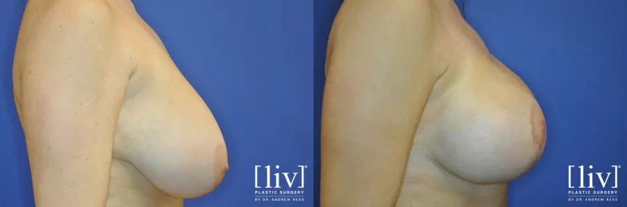 Breast Lift And Augmentation: Patient 6 - Before and After 3