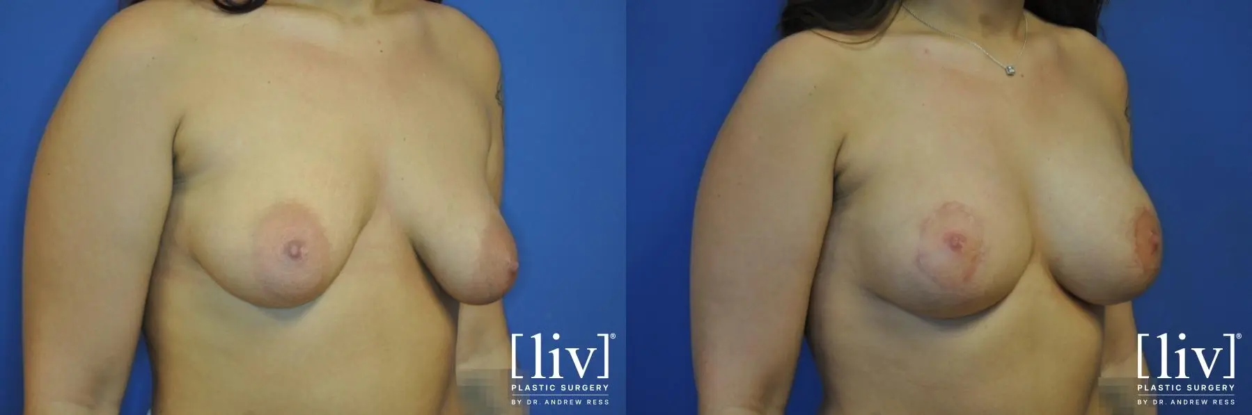 Breast Lift And Augmentation: Patient 5 - Before and After 4