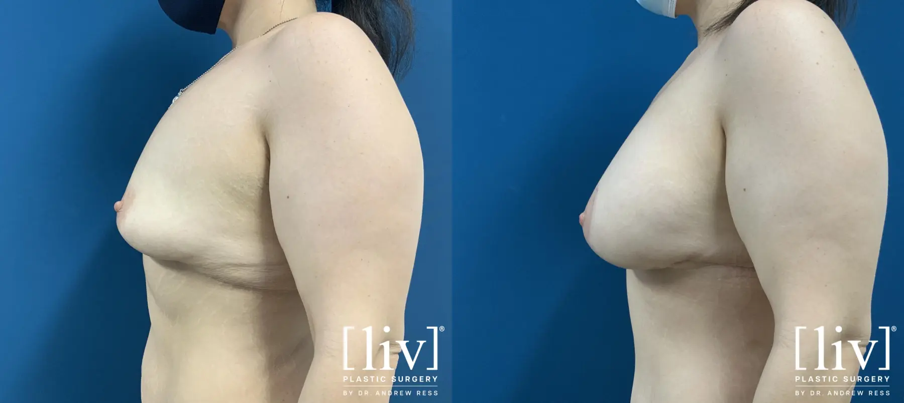 Breast Lift And Augmentation: Patient 15 - Before and After 3