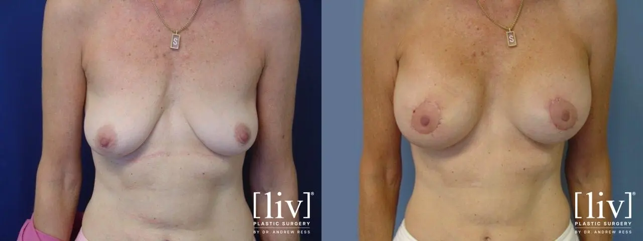 Breast Lift And Augmentation: Patient 8 - Before and After 1