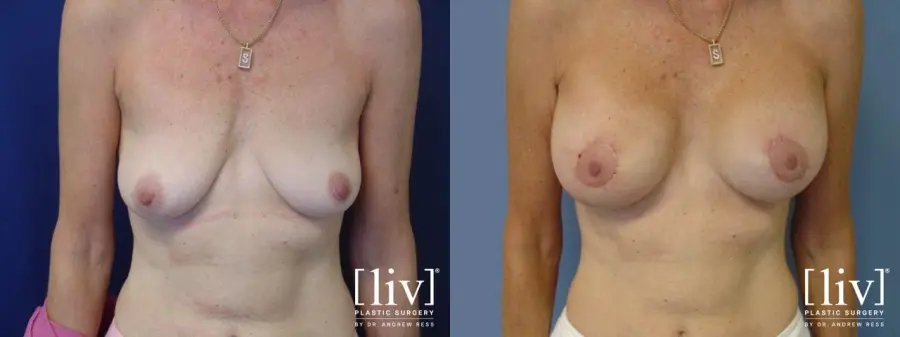 Breast Lift And Augmentation: Patient 8 - Before and After  