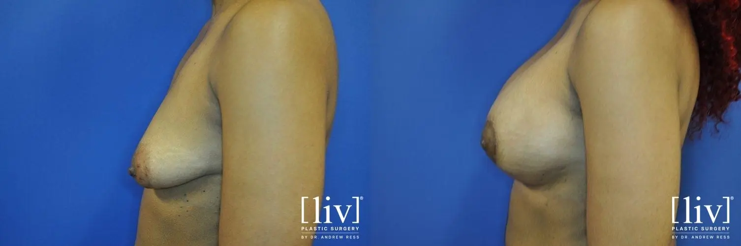Breast Lift And Augmentation: Patient 11 - Before and After 3