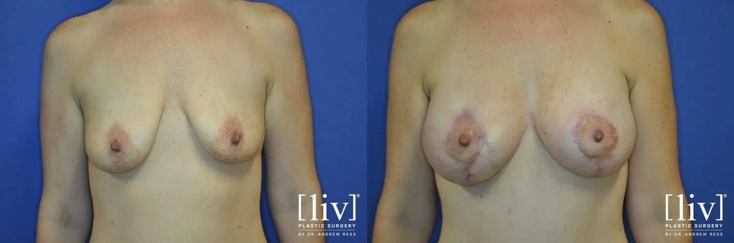 Breast Lift And Augmentation: Patient 7 - Before and After 1