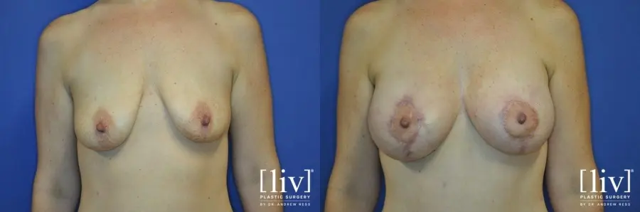 Breast Lift And Augmentation: Patient 7 - Before and After 1