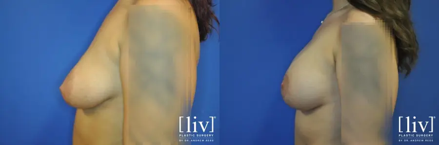Breast Lift And Augmentation: Patient 5 - Before and After 3
